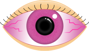 Eye_department_pink-eye_cartoon