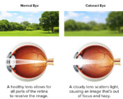HOME 19 Do I Need Cataract Surgery Yet
