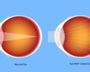 HOME 18 cataracts impacting driving call eye department.portland