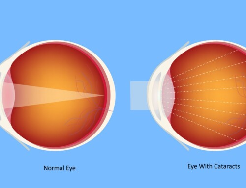 Do I need cataract surgery yet?
