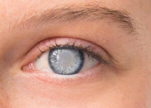 Signs your cataract might need surgery in Portland, Oregon