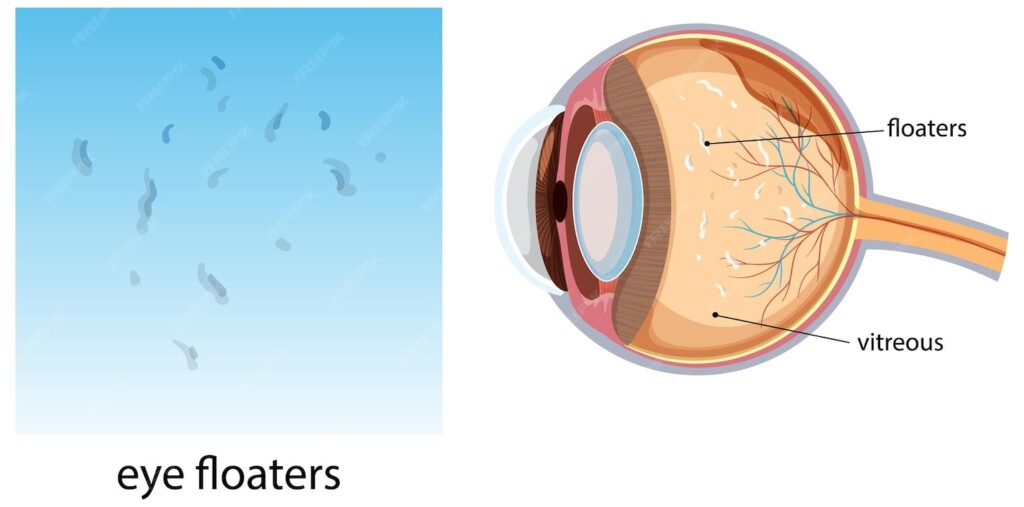 Are Eye Floaters or Flashes of Light a Sign of a Serious Problem? 2 eye-floater-diagram-eye-department