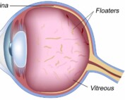 HOME 20 eye floaters emergency eye care portland eye department best eye doctor near me