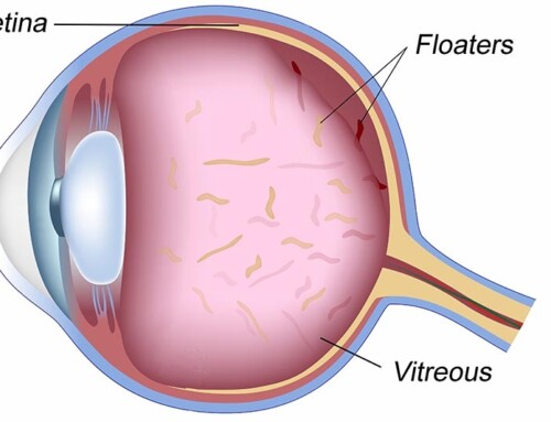 Are Eye Floaters or Flashes of Light a Sign of a Serious Problem?
