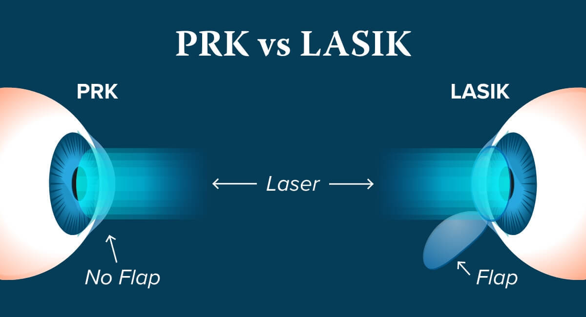 Vision Correction Procedures PRK vs LASIK Surgical Comanagement